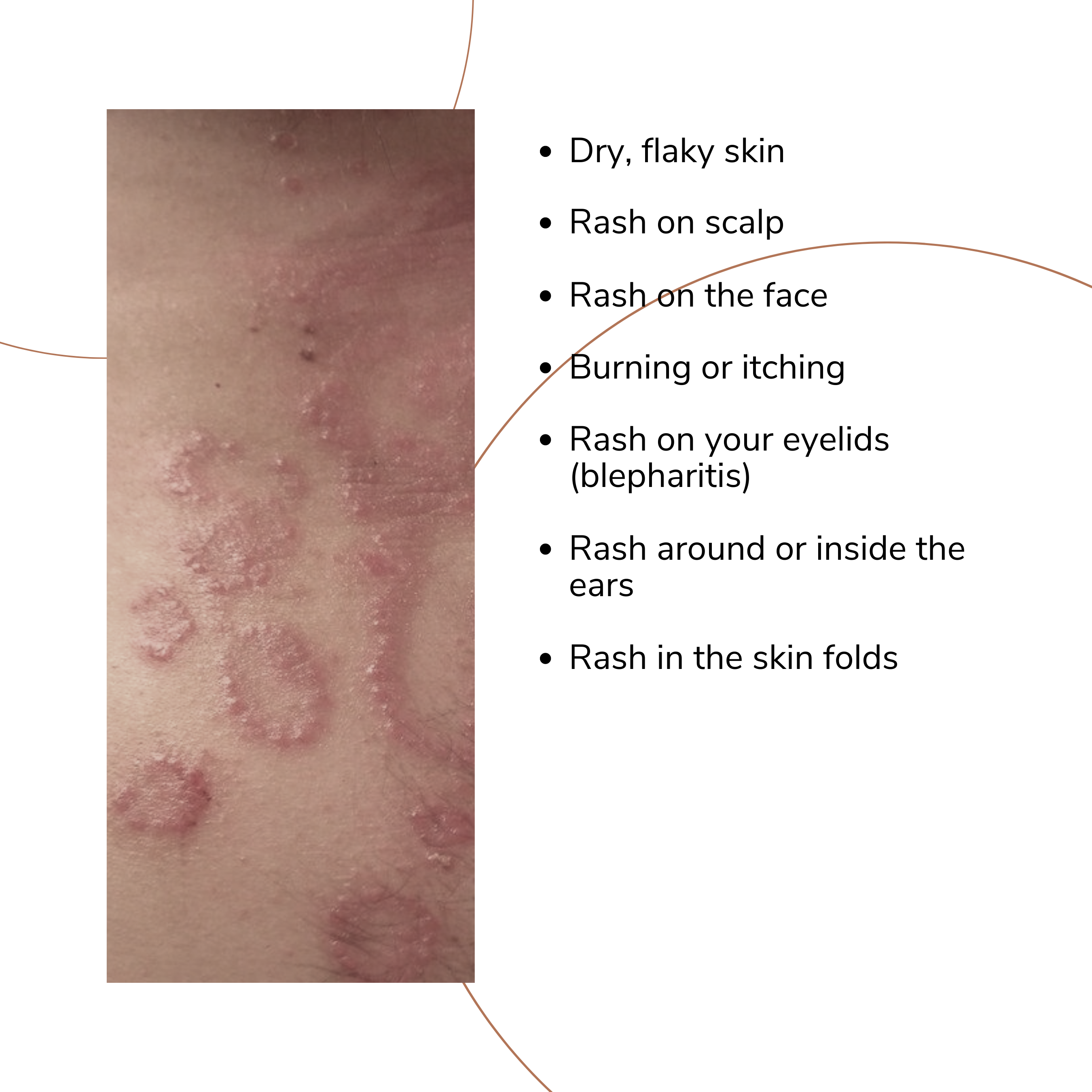 Seborrheic Dermatitis Body Rash Seborrheic Dermatitis – Dermtropics
